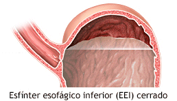 esfinter-esofagico-cerrado