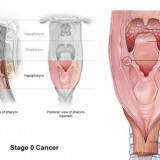 cancer-de-garganta