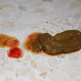 diarrea-sanguinolenta