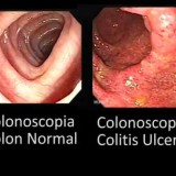 colitis ulcerosa