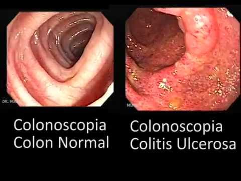 Resultado de imagen de colitis ulcerosa