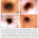 esofagitis-eosinofilica-luis-lvarez-valos-20-638