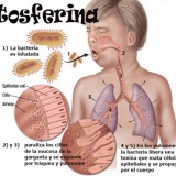 tosferina-infografc3ada